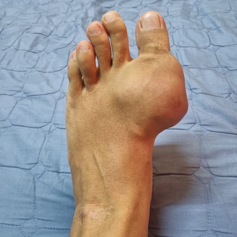 keradangan kaki akibat gout. Dapatkan ubat gout